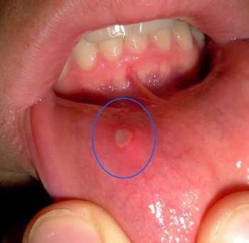 CBD - סיבידי ופצעי אפטה בפה